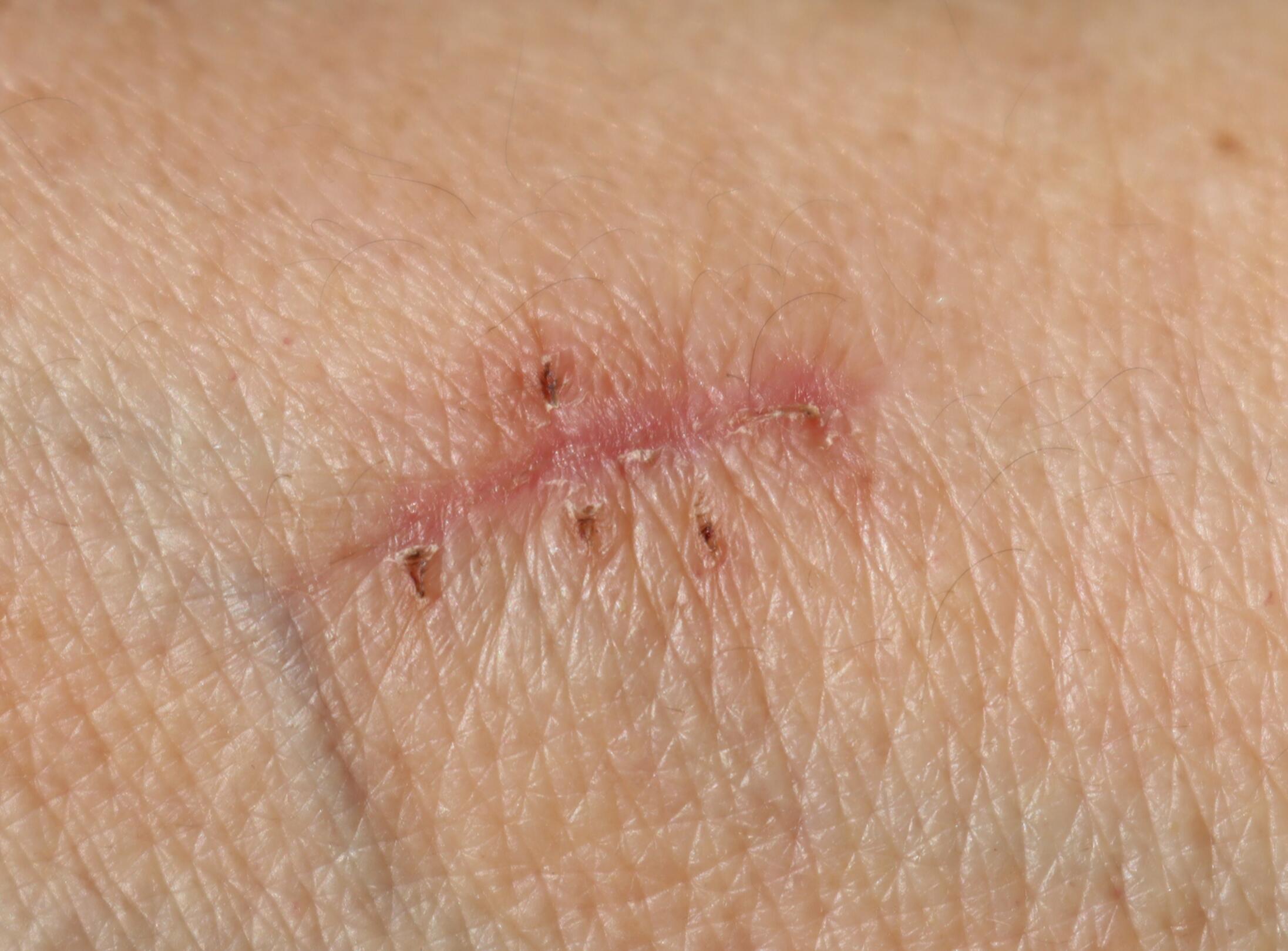 processo di formazione delle cicatrici